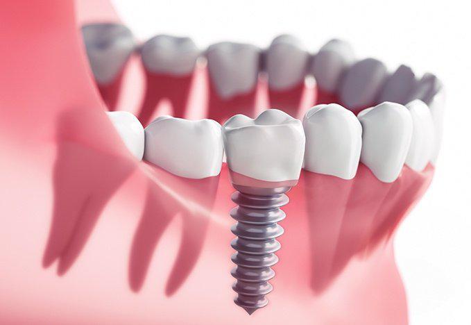 Dental Implants: Concord CA dentist