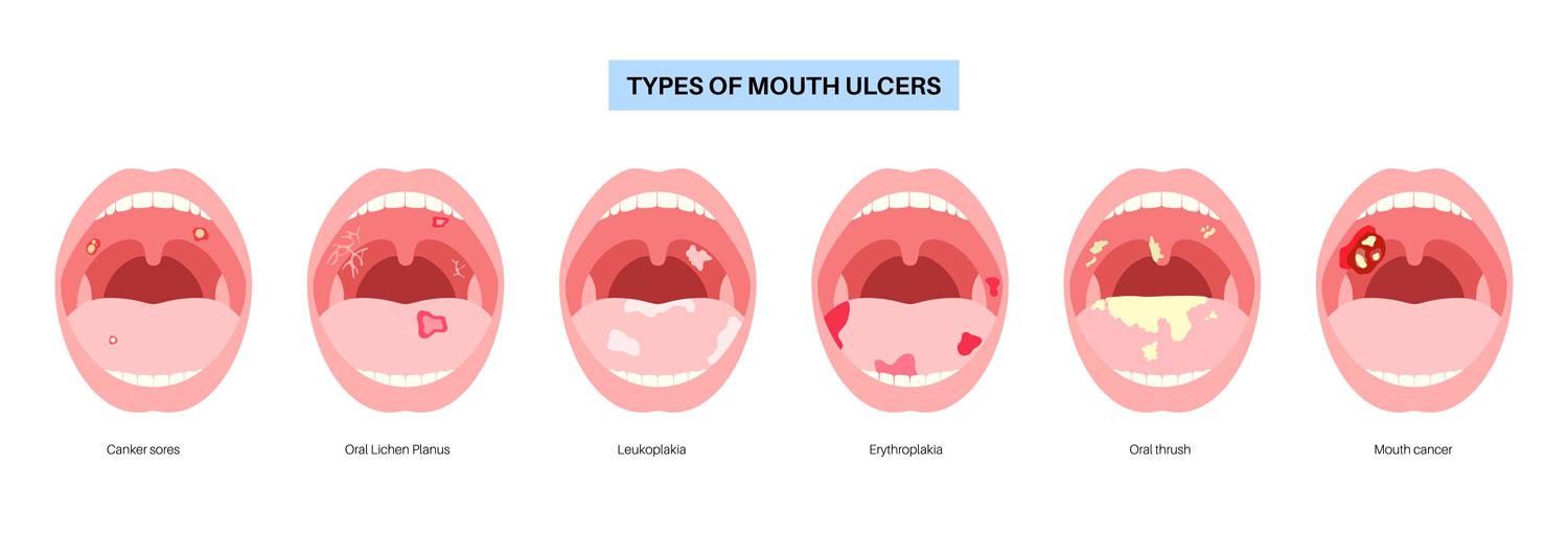 How to identify potential for oral cancer