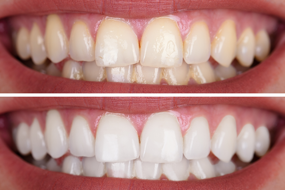 before and after picture of dental patient with teeth whitening