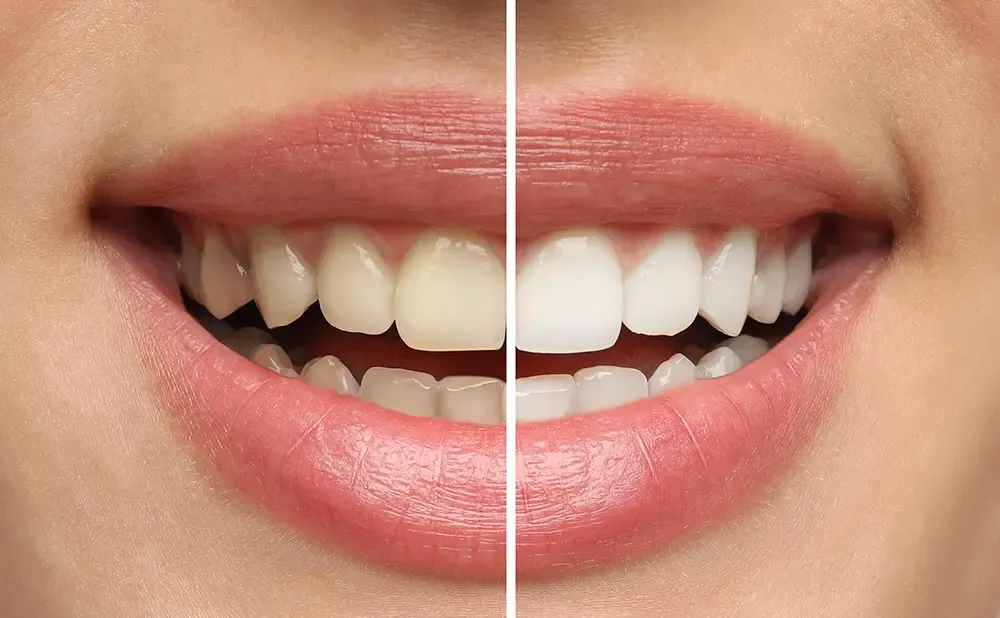 before and after professional teeth whitening in Concord, CA